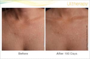 Ultherapy Before & After Chest